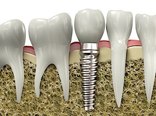 Εμφυτευματα δοντιων, implants, Οδοντιατρείο πειραιά