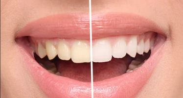 Λευκανση δοντιων